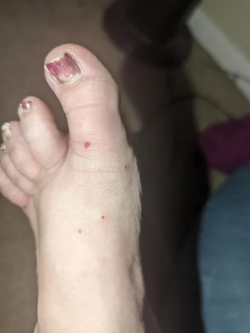 Forbidden pops. Fire ant bits. I'm allergic so my toe is swollen too.