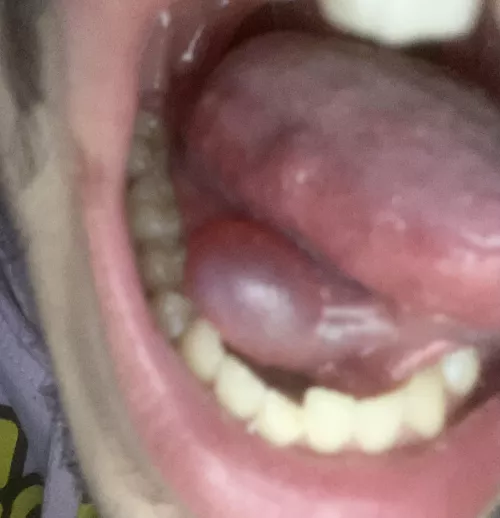 Bubble under my tongue