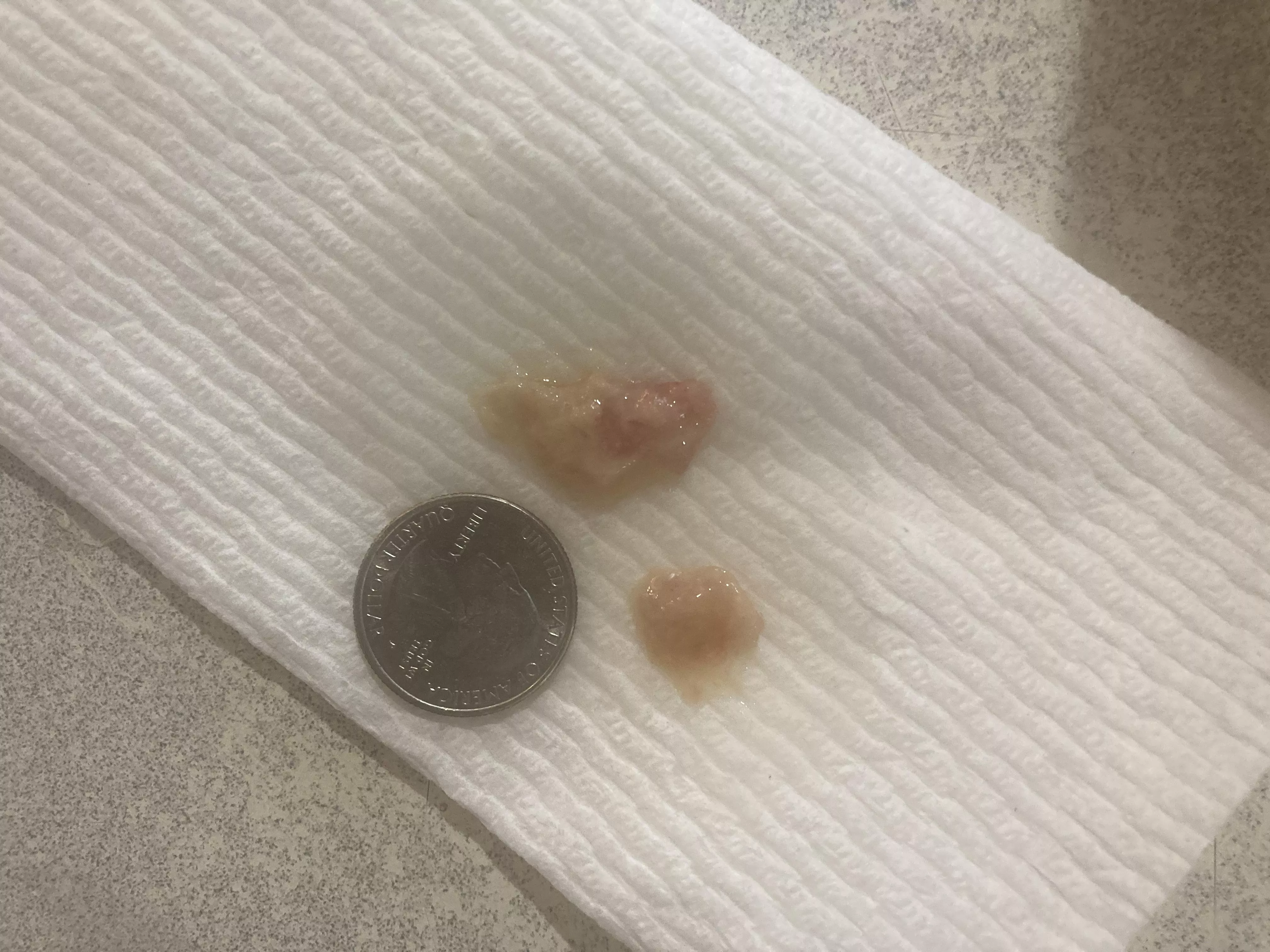 This came out of my sinuses this morning - no clue what it is.