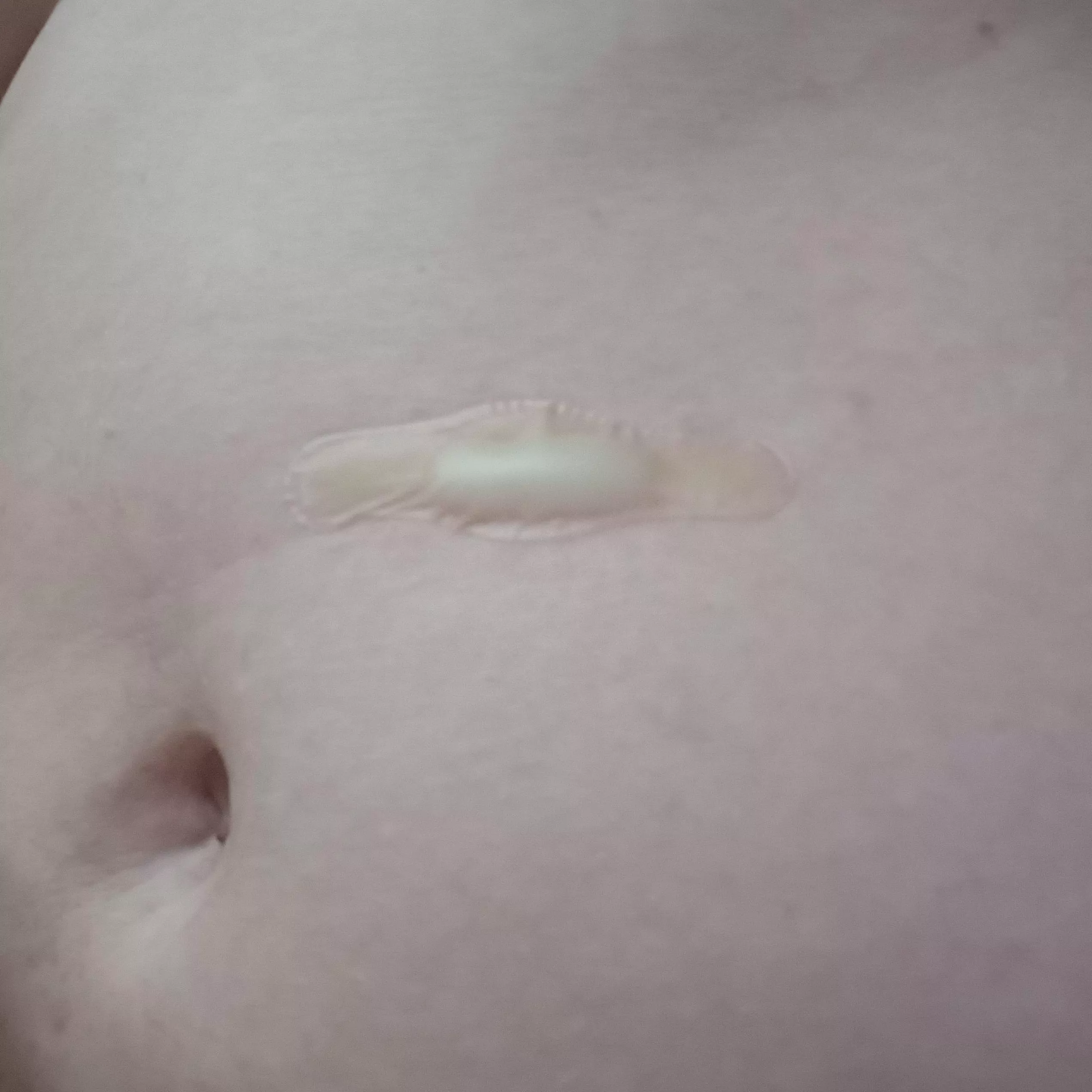 using a hydrocolloid patch for its intended purpose: testing burns