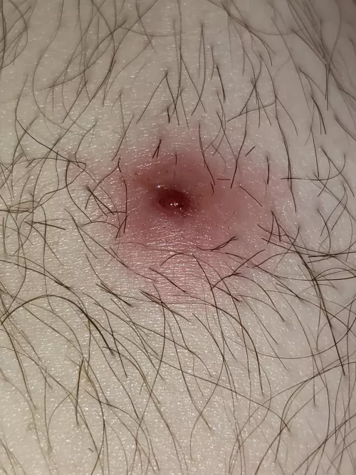 Cyst finally drained while in the shower without my seeming to have to do anything. Have questions.
