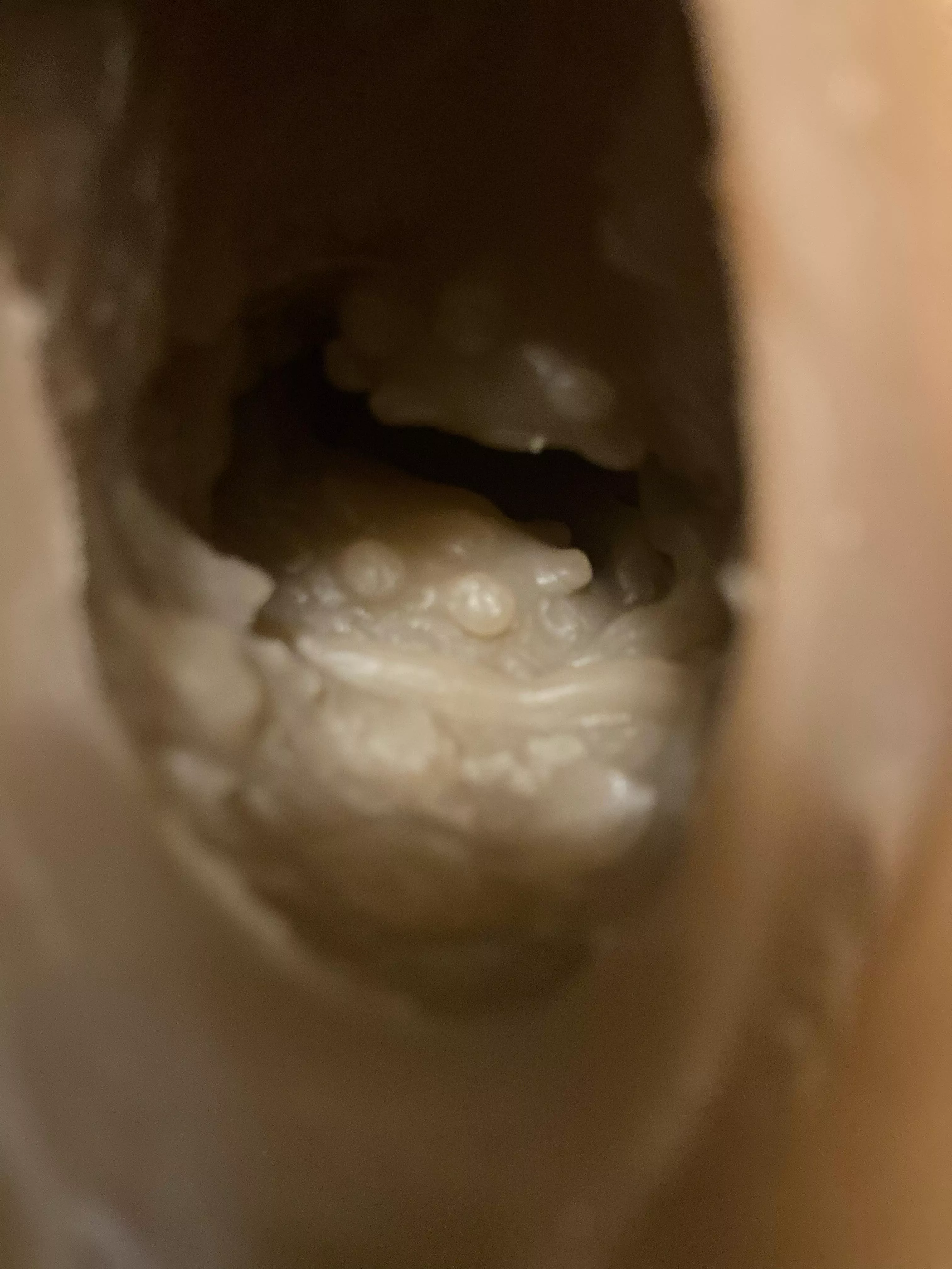 How to smooth out these vagina bumps? Can’t find any videos on a heating rod to the vagina/anal.