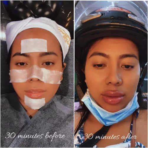 I just had a lip filler done sponsored by a generous, hot daddy! Iβm gonna take lots of photos and videos all dolled up, but I just wanna share this now (Iβm that excited!) How do my new bimbo lips look? I had a facial before the procedure (not the k