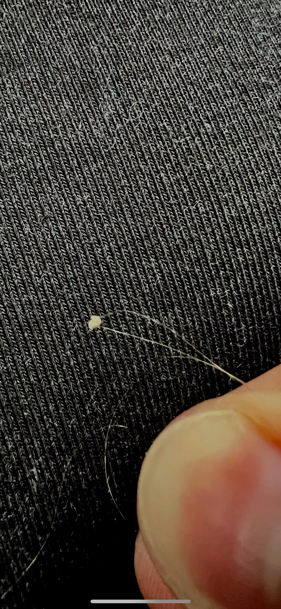 Deep cystic sit i’ve been digging my at in back of my head for 2.5 weeks