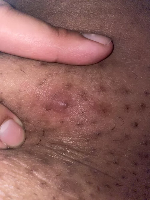 I’ve been trying to pop this angry dude on the inside of my thigh since yesterday and it’s being stubborn :(