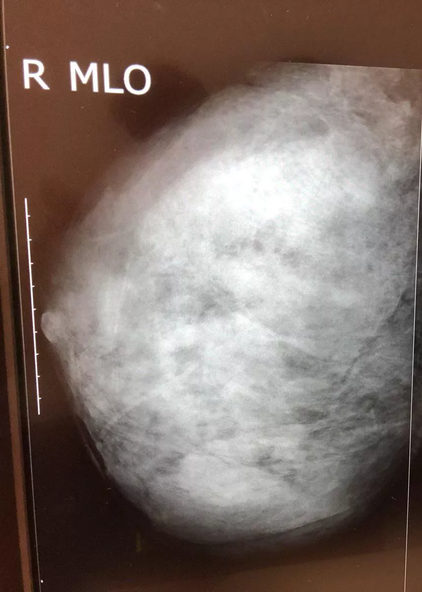 An official mammogram (X-ray of her titty)
