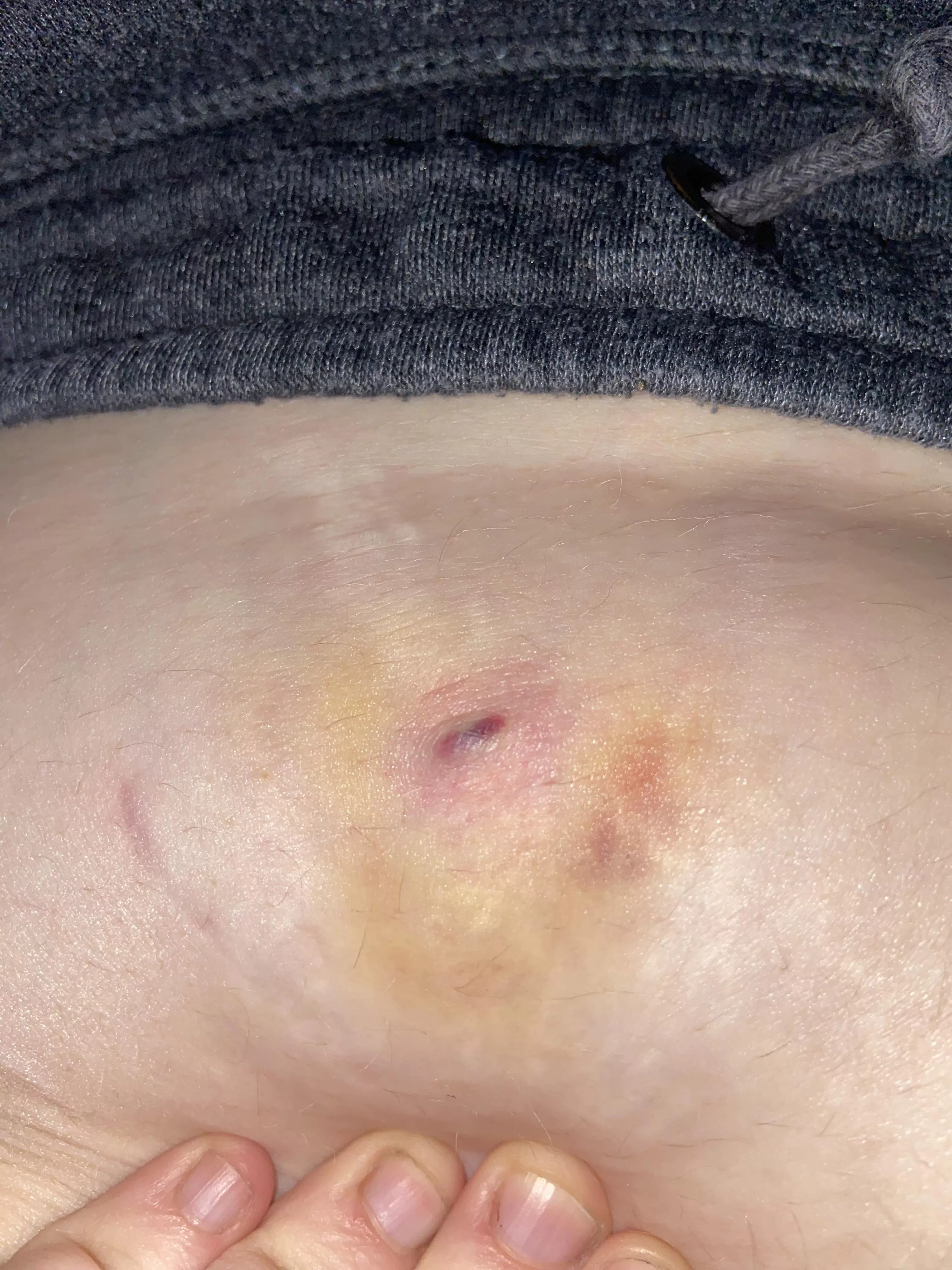 This lump appeared on my tummy in a stretch mark a few days ago and now has a dark line in it that looks like blood. Not sure what it is or why it’s started to bruise as I e tried to leave it alone.