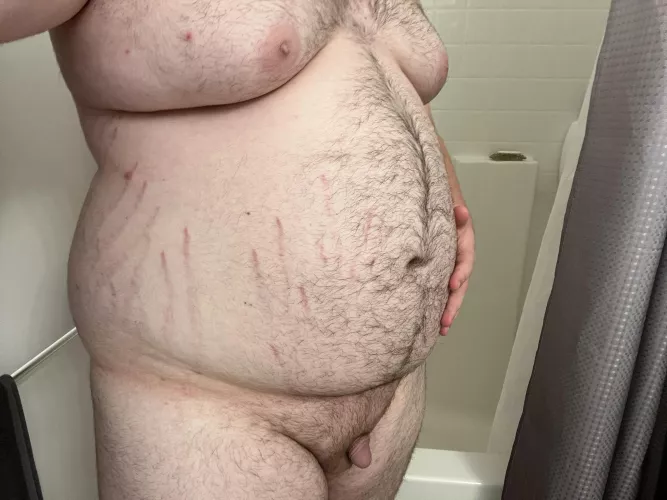 My stretch marks are getting bigger
