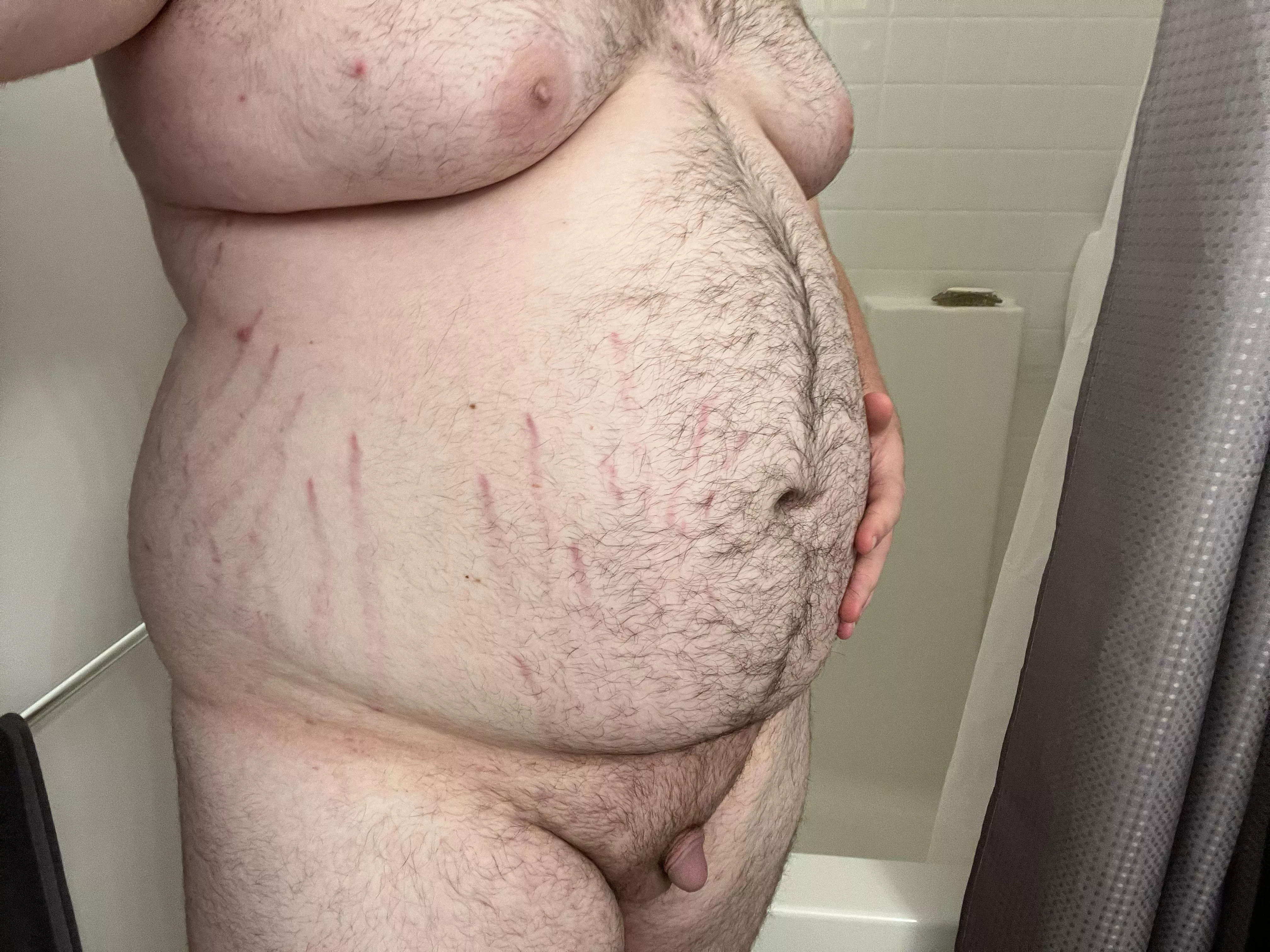 My stretch marks are getting bigger