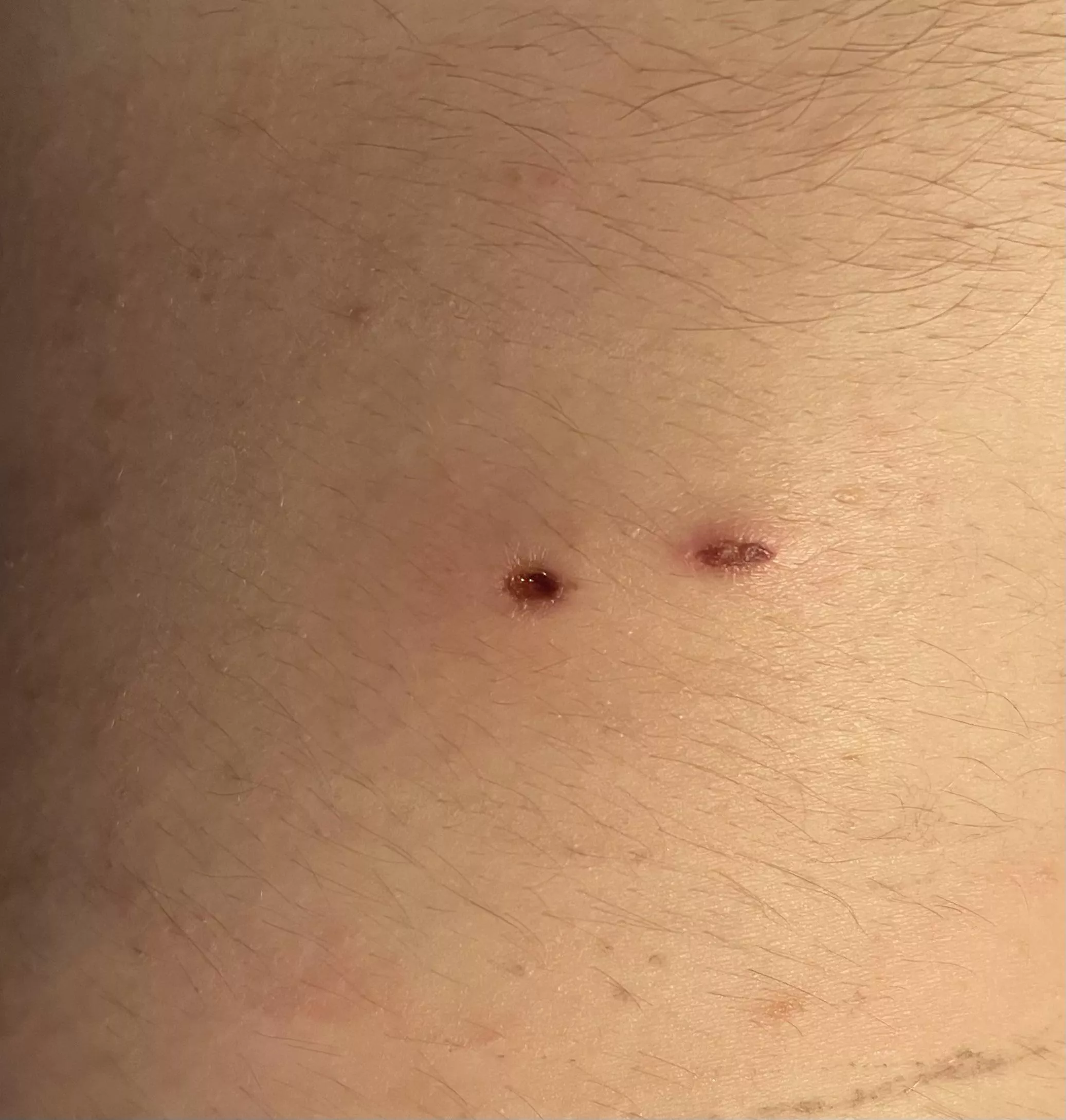 The hole my infected cyst left after getting drained. Can’t decide if I should cover it or let it breathe.