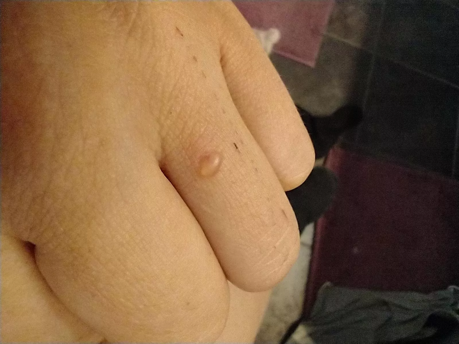 Forbidden pop that appeared yesterday - it's not from heat or friction, probably an insect bite of some kind. The temptation 😮‍💨