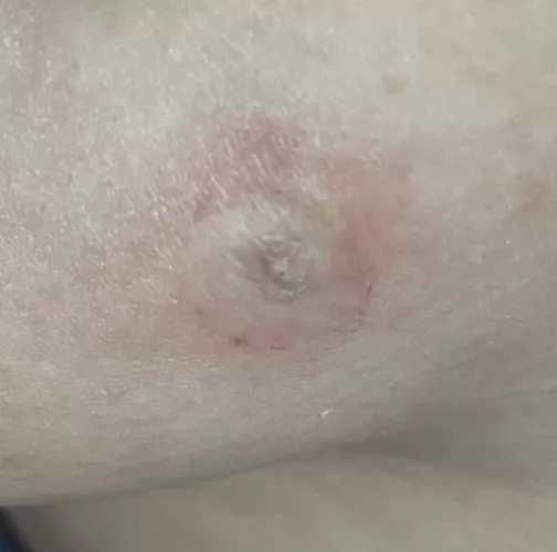 I wanna pop this so bad but I was taught not to pop pimples…