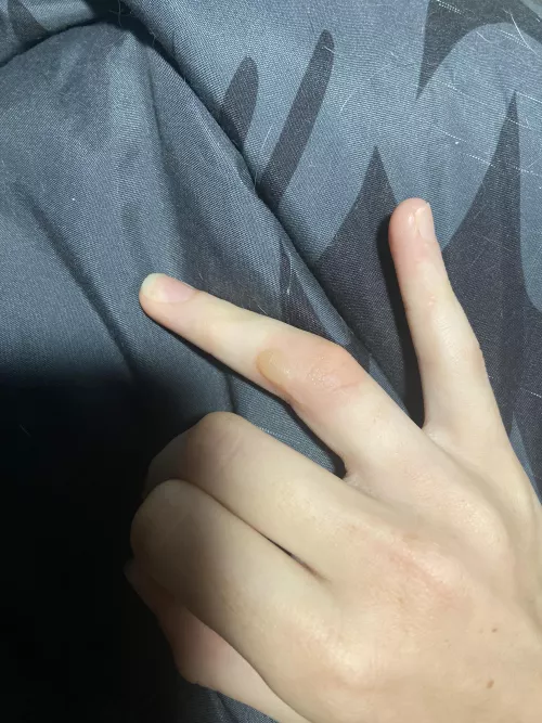 Forbidden pop on finger