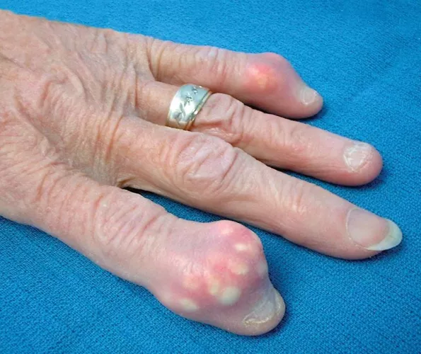 So is gout what we're getting into next?