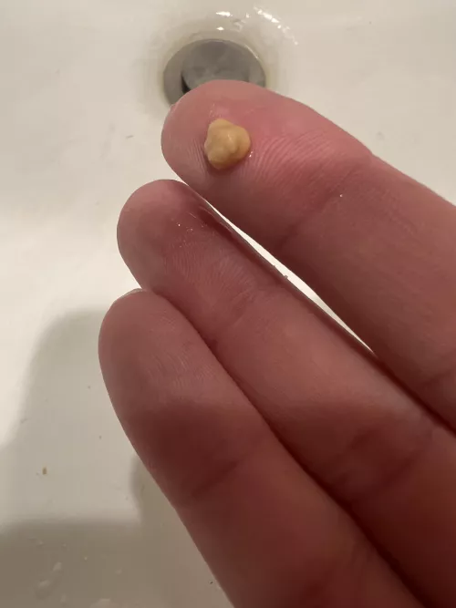 Biggest tonsil stone yet