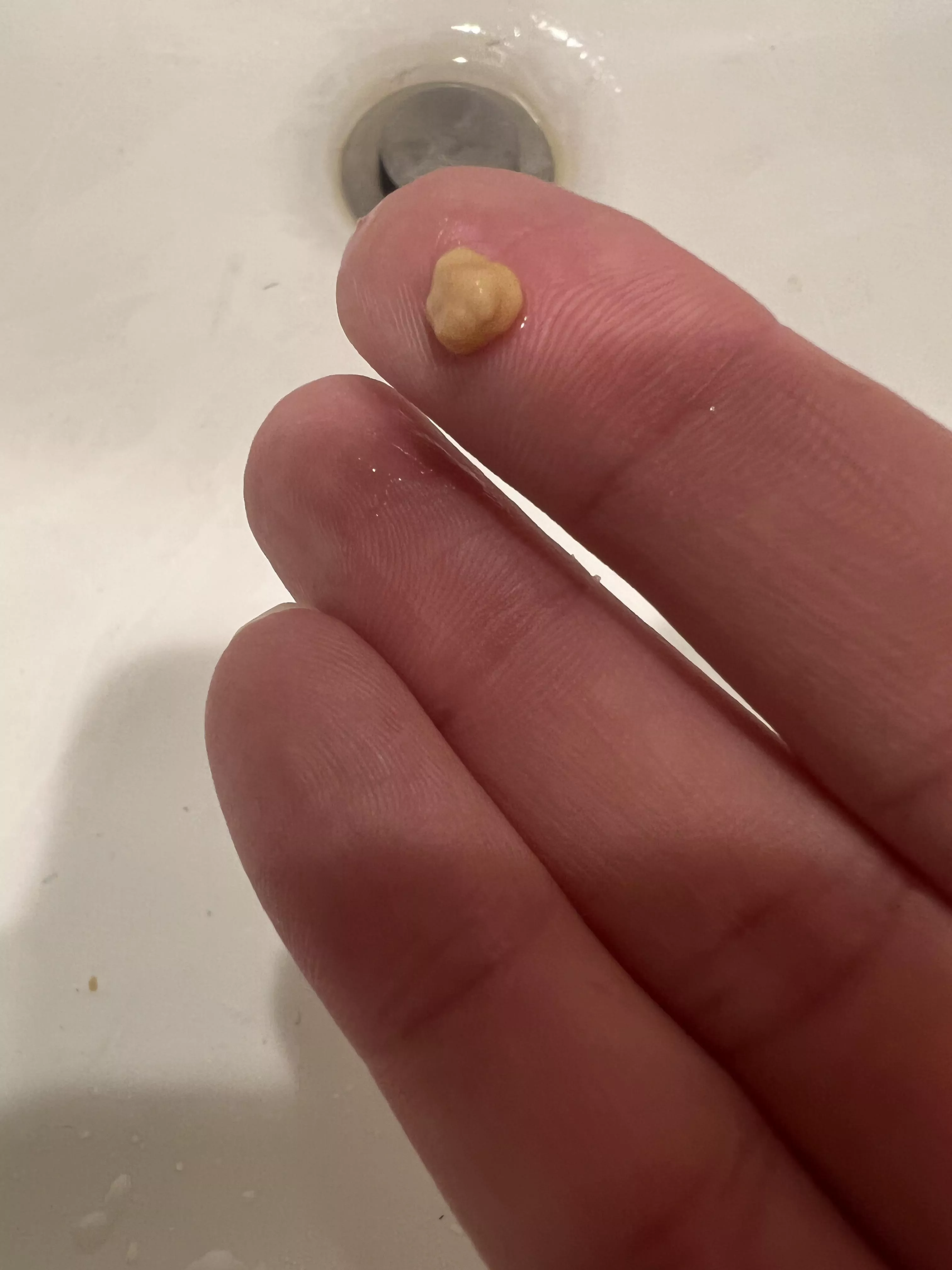 Biggest tonsil stone yet
