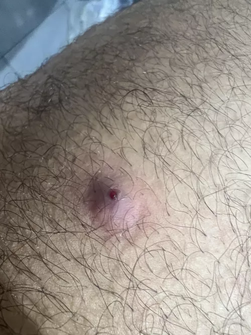 Pretty painful and have had this lump on my inner thigh for 5 days. Tried to pop with no success, just oozed blood. What could it be?
