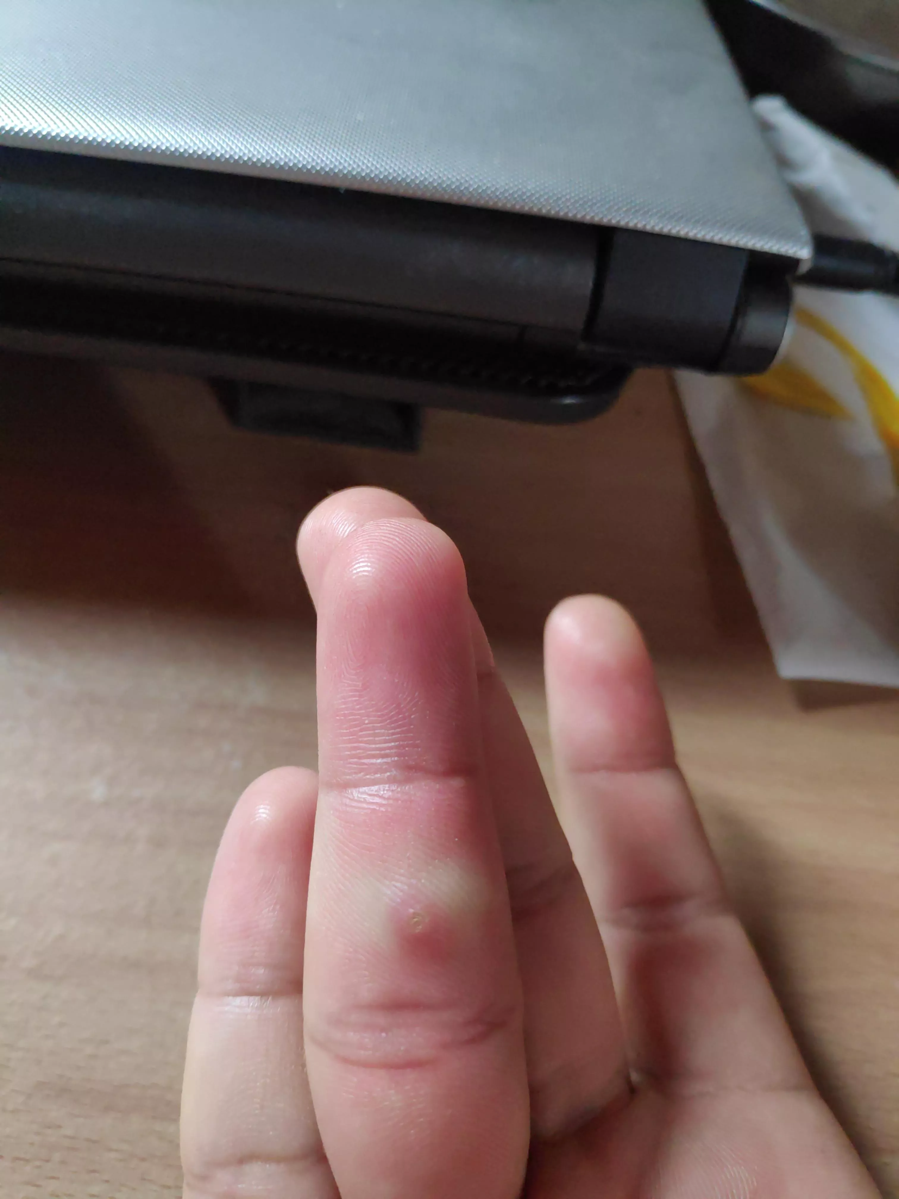 This blister was small but curiosity got best of me and I pinched it, should not have done that, It grew a little bit bigger. Looks like there is some mass on it's either side. Do anyone know what it might be?
