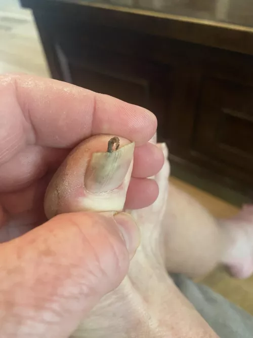 Treating Toenail Fungus. Gave my Toe a Little Squeeze and This Came Out