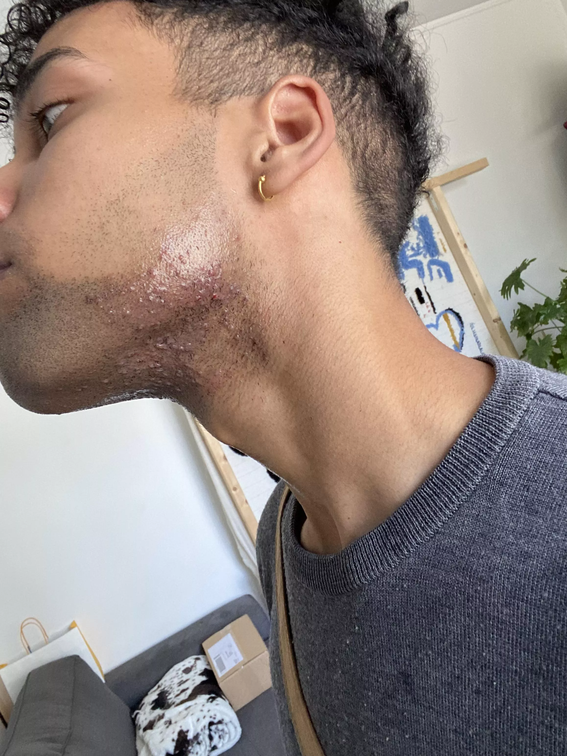 Ingrown hairs and irritations on beard