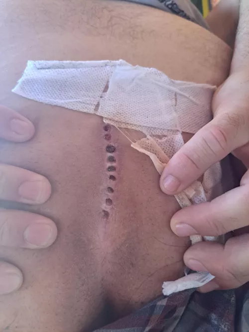 Got surgery for my cyst done. Hurts like all hell.