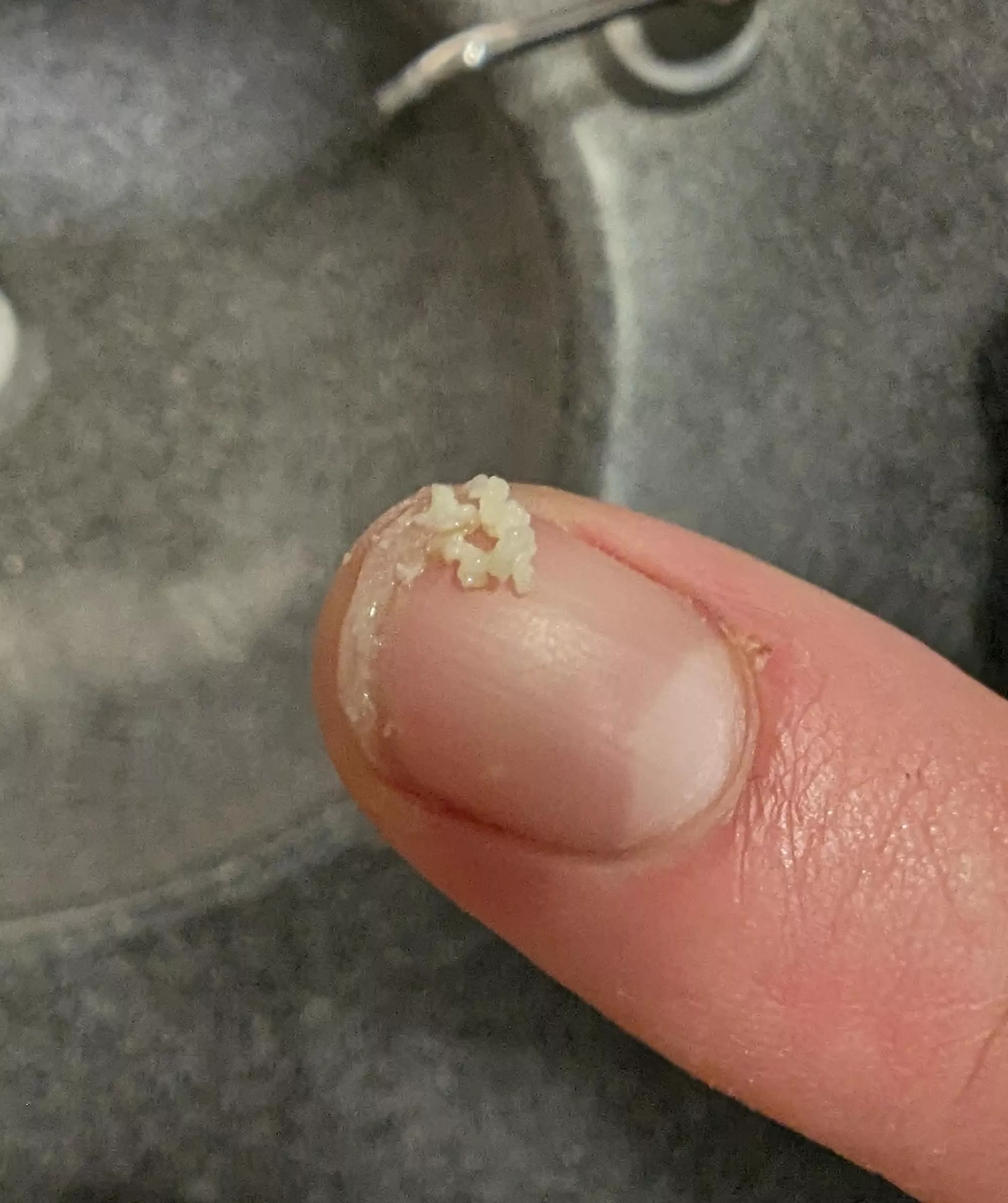 There's a pore on my cheek that fills up every couple weeks