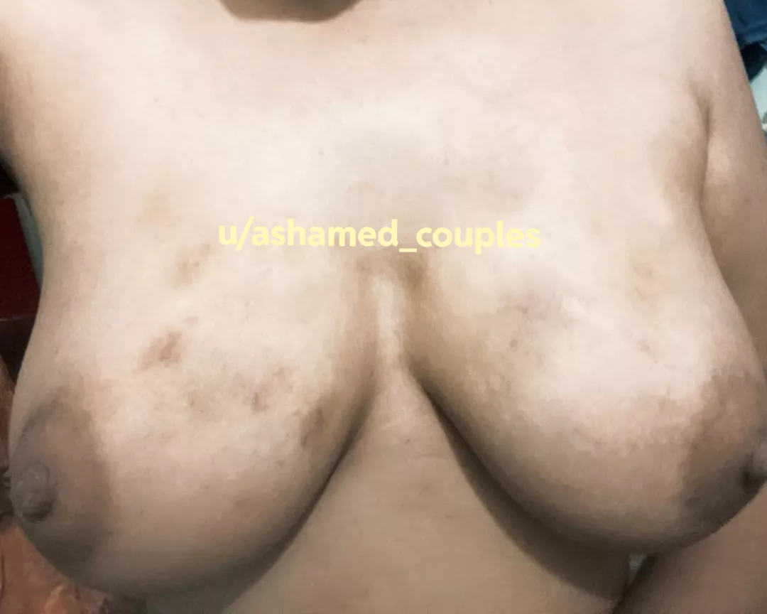 Decided to meet my ex-b(f) secretly but how do i hide my marks now ?