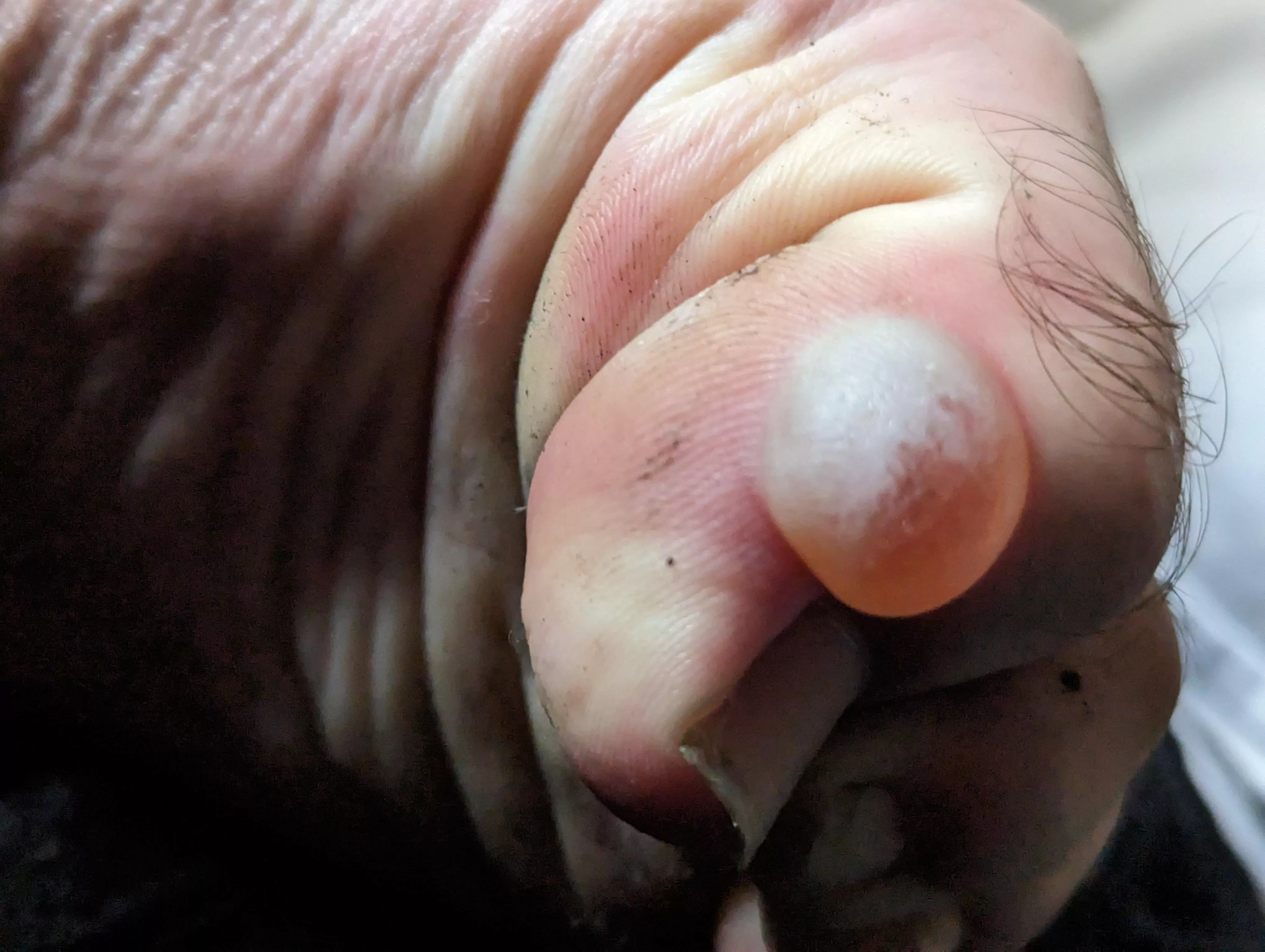 Should I pop this? Hiked for 5 days through mountains