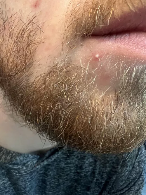 Woke up to this whitehead out of nowhere