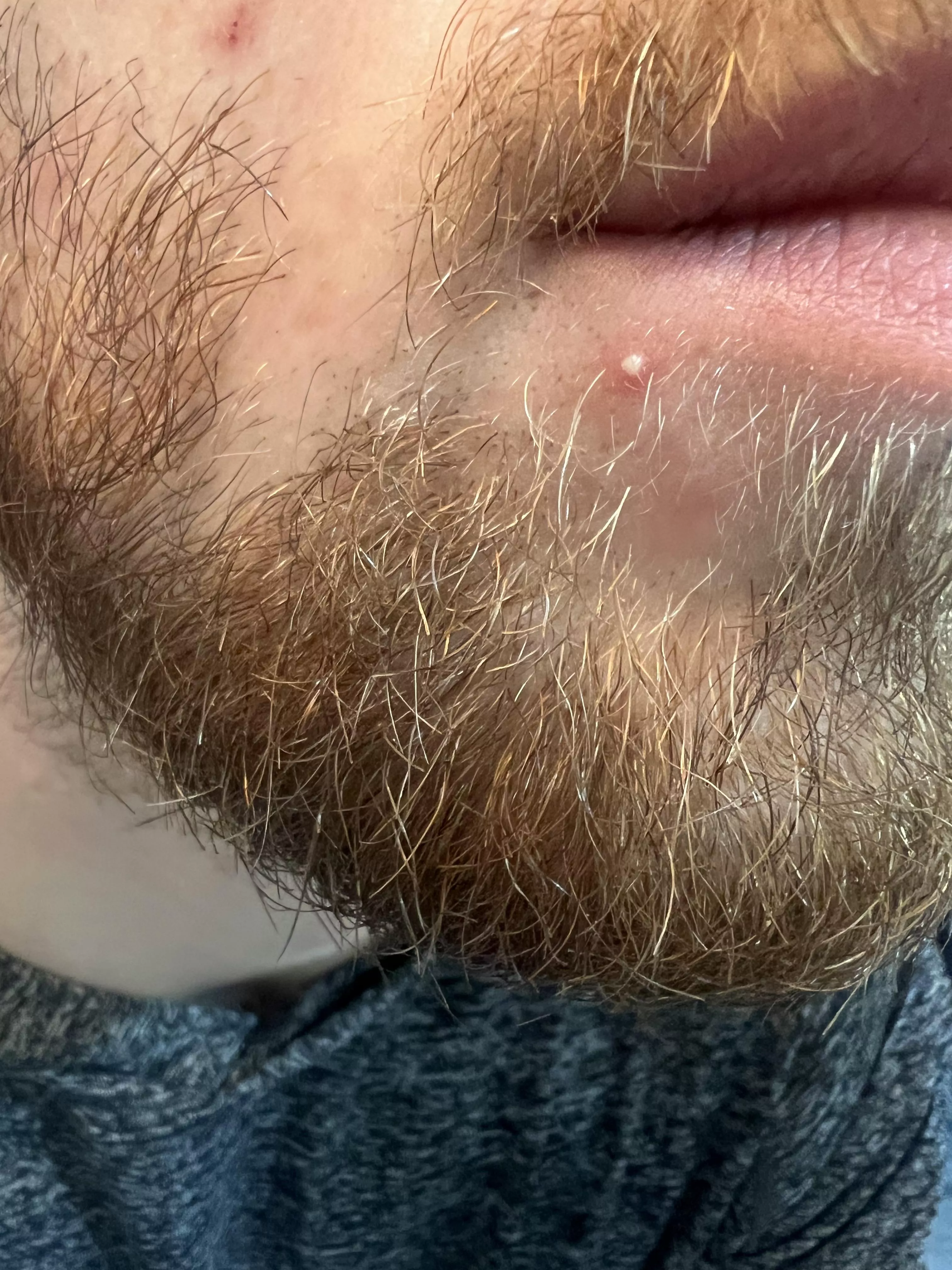 Woke up to this whitehead out of nowhere