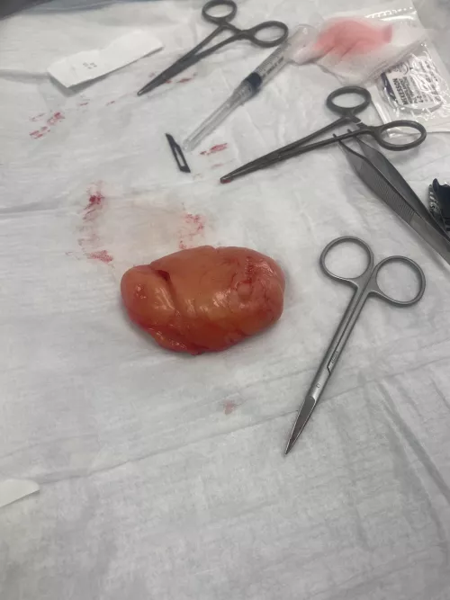 Lypoma removed today
