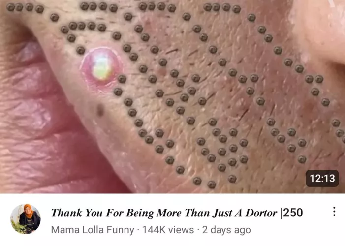 I love when pimples line up so perfectly like this! (Looks totally legit)