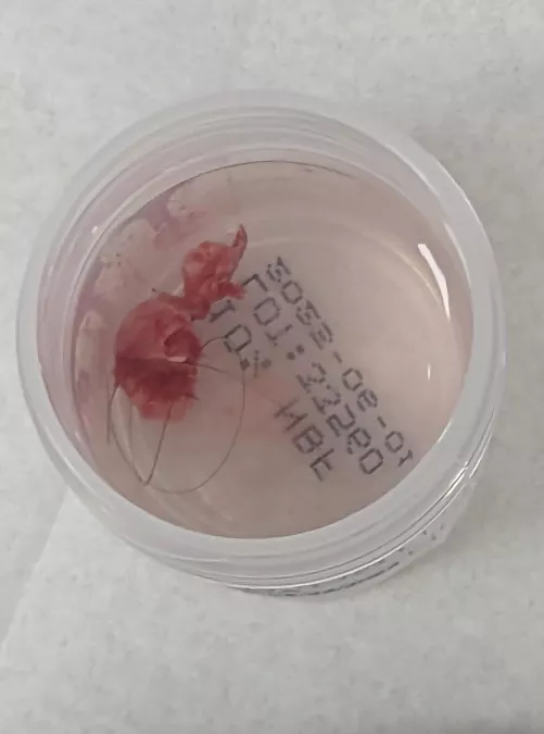 Operation Cease and De-cyst, part VI!