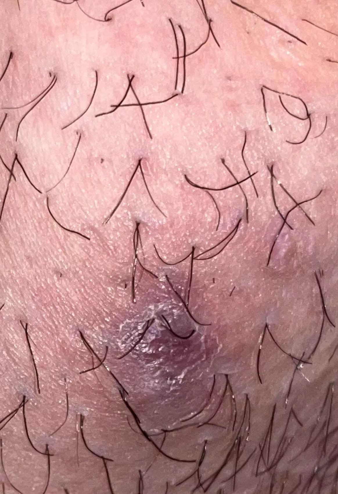 Boil on bikini / vagina area