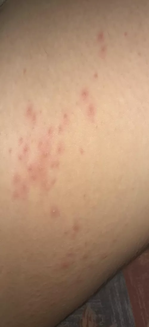 Forbidden pops from chafing