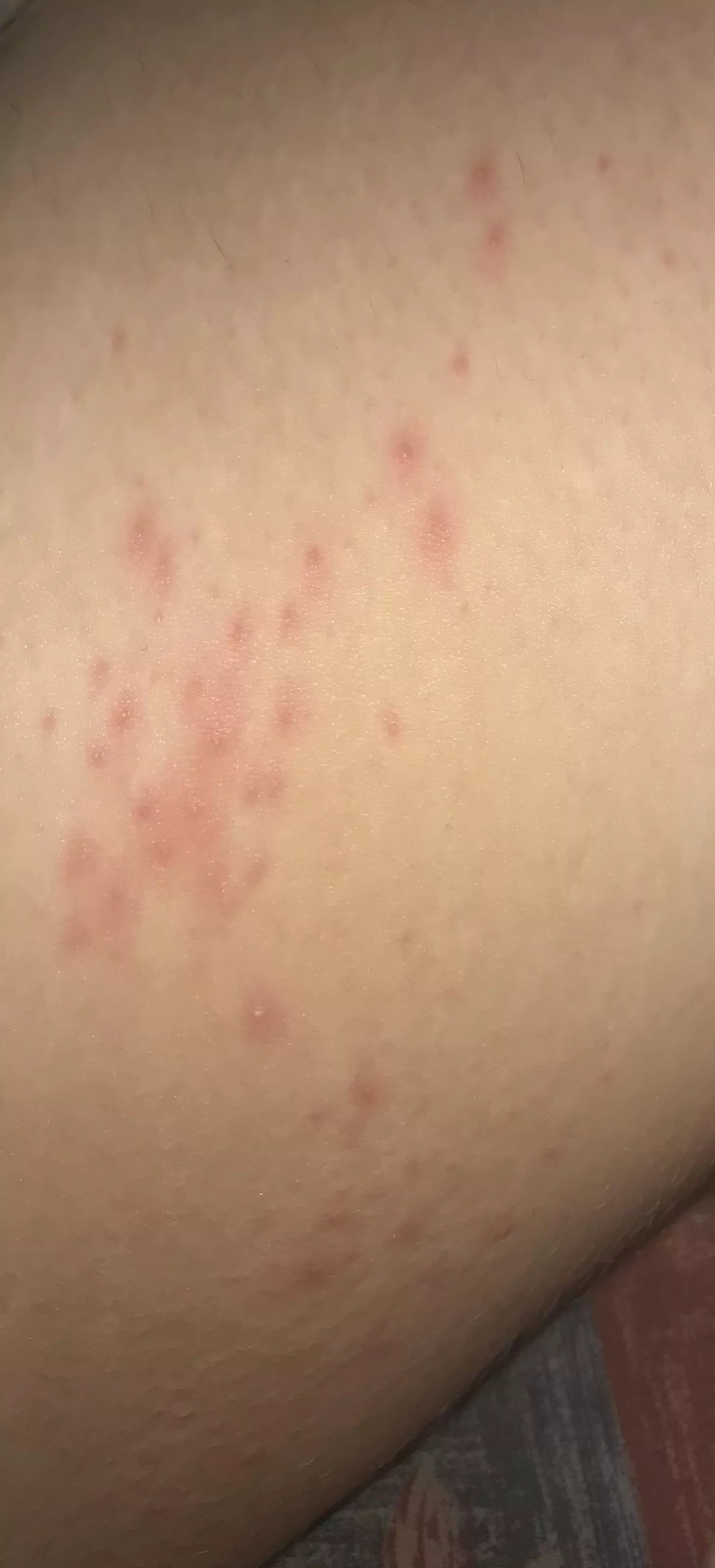 Forbidden pops from chafing