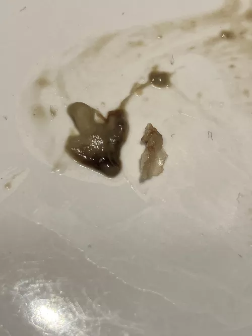 I got couple of wisdom teeth removed 10 days ago. This came out of my mouth today.