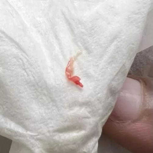 This came out of my ear. It was the second of two full grown worms. The mucus surrounding it is yolky milk for its children. I cleared everything out of my ear through a 3-week cleaning process.