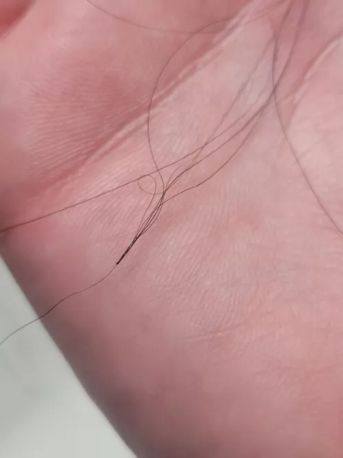 I think this is folliculitis