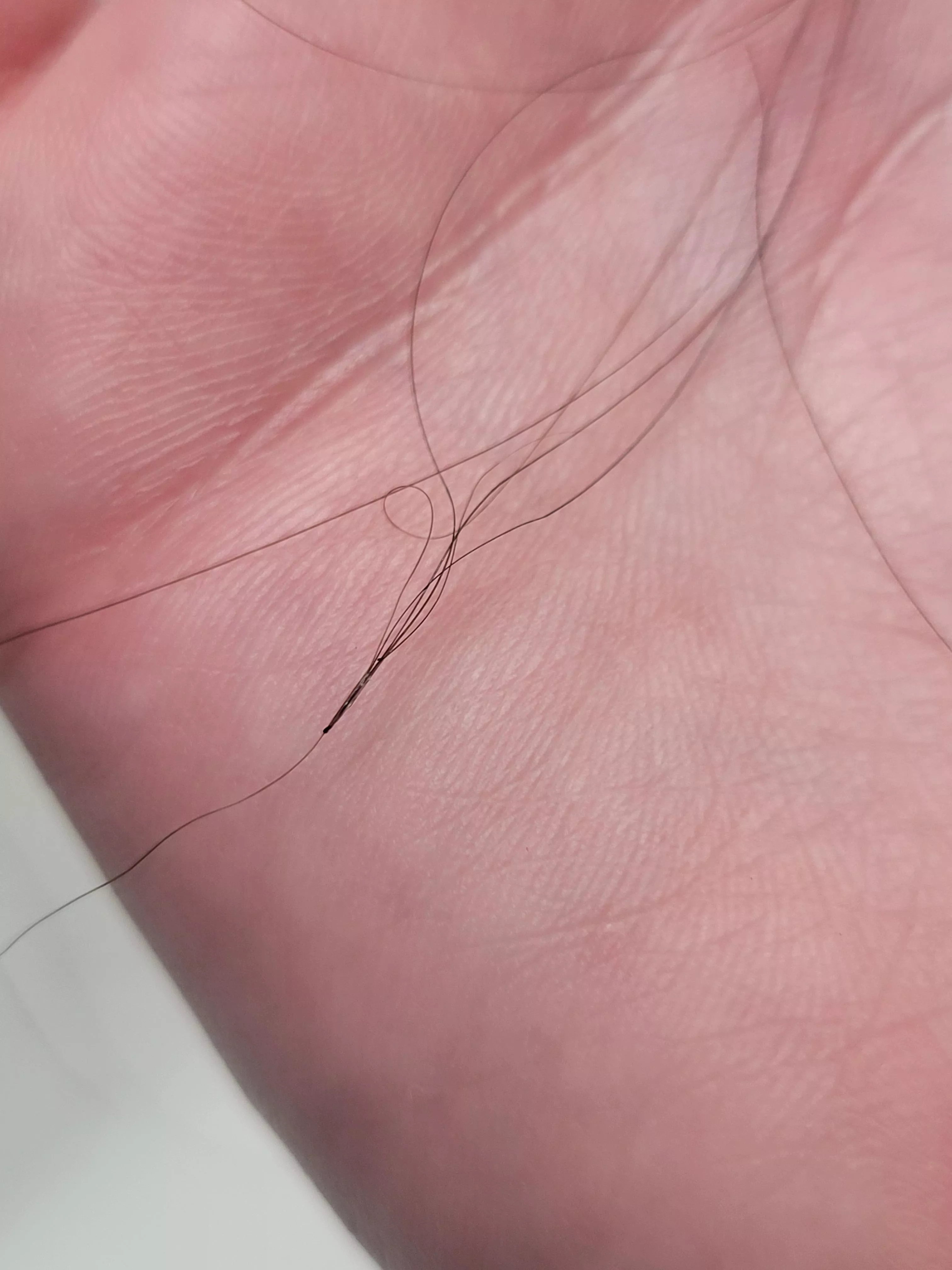 I think this is folliculitis