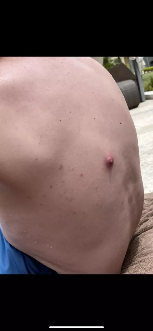 Three years ago partner never told me he had a blackhead. He spent 14 hours on a plane and when we got off it looked like this. It popped a day later (the amount that came out my lord) and never came back. What was it? Tia