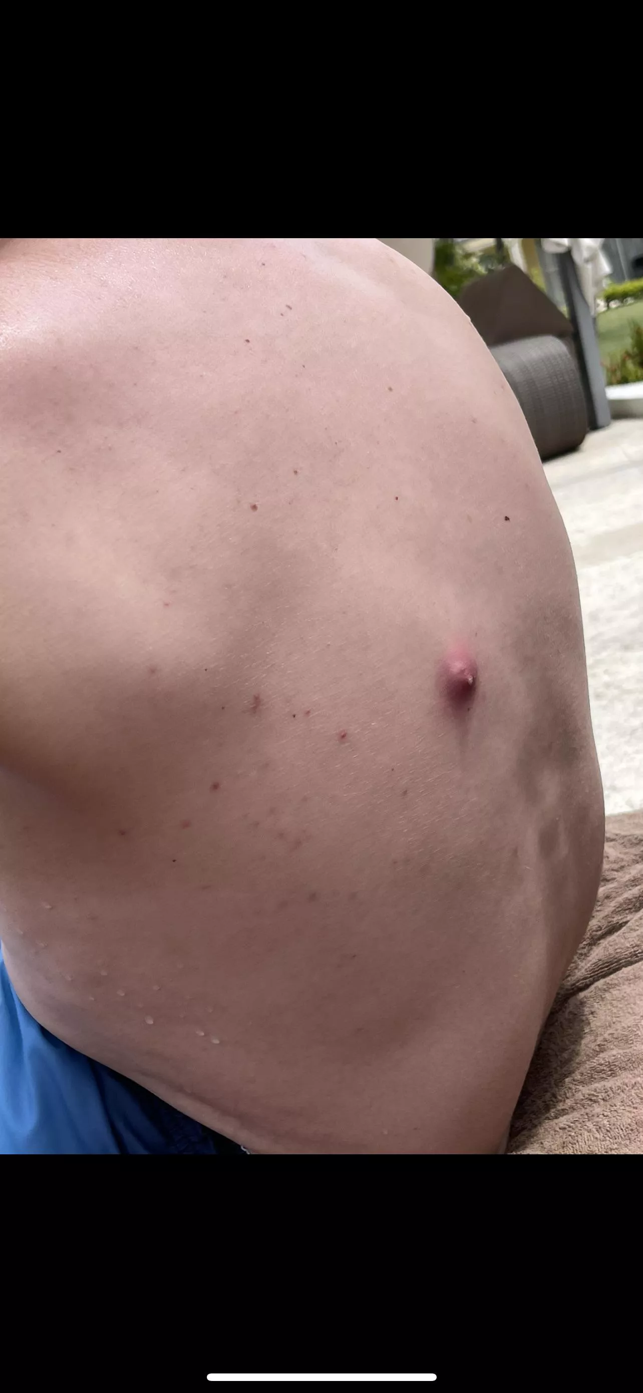 Three years ago partner never told me he had a blackhead. He spent 14 hours on a plane and when we got off it looked like this. It popped a day later (the amount that came out my lord) and never came back. What was it? Tia