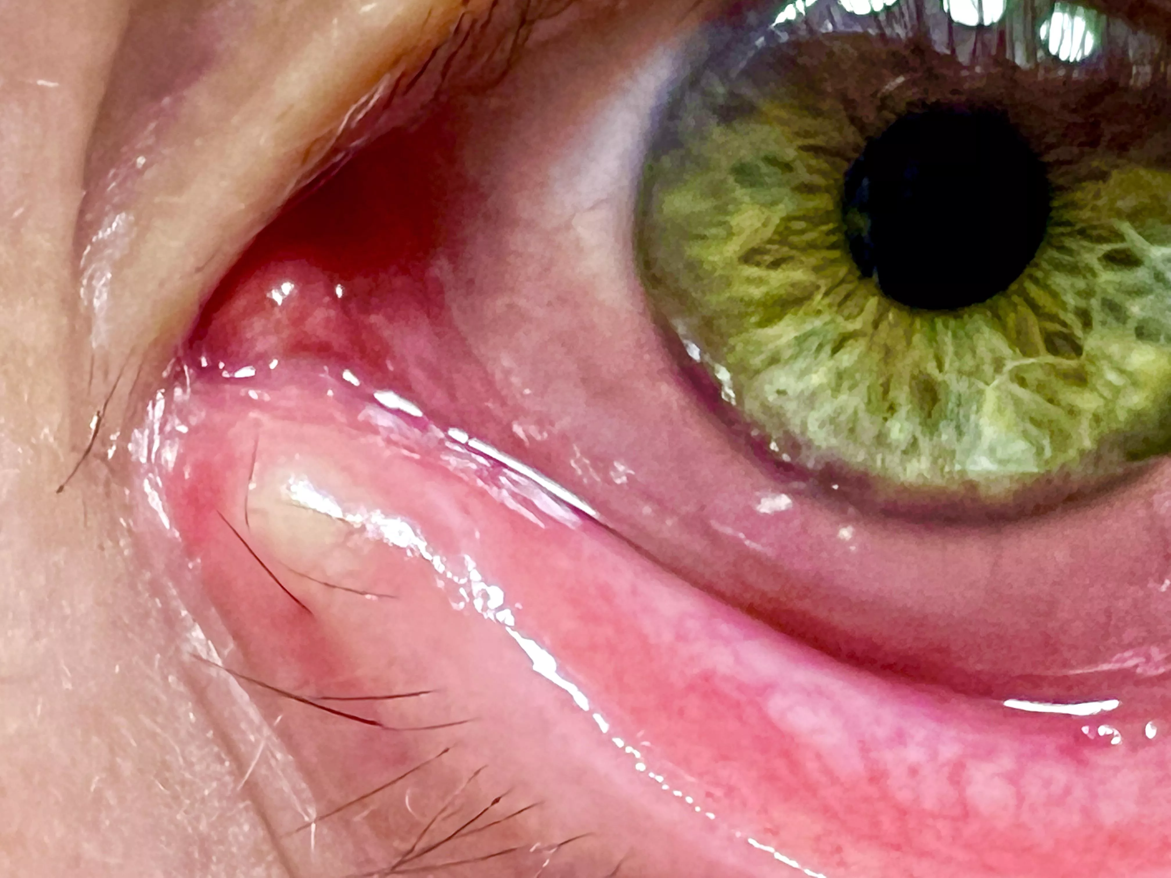 Day 3 of This Stye *Right* on my Tear Duct