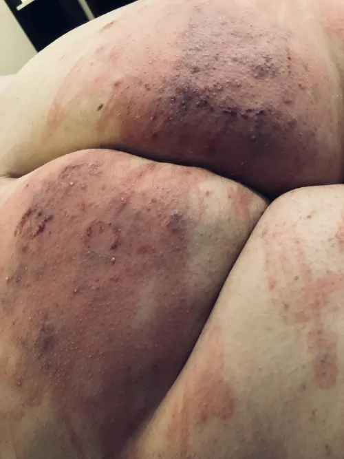 My favorite set of bruises