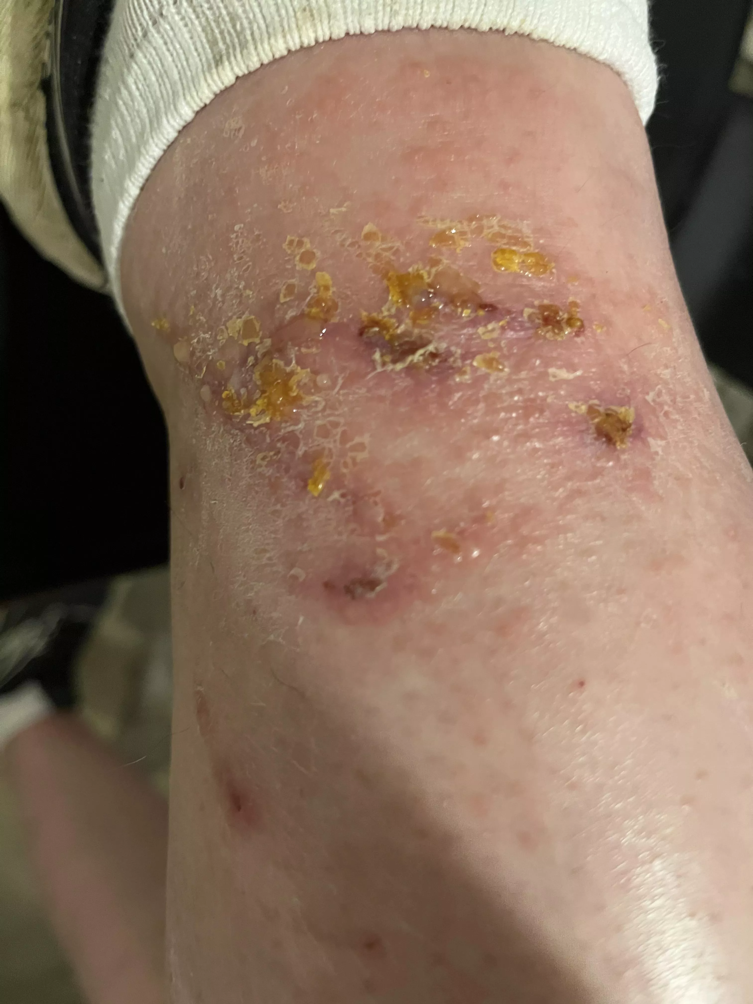 What happens when you pick at and scratch a poison ivy rash.