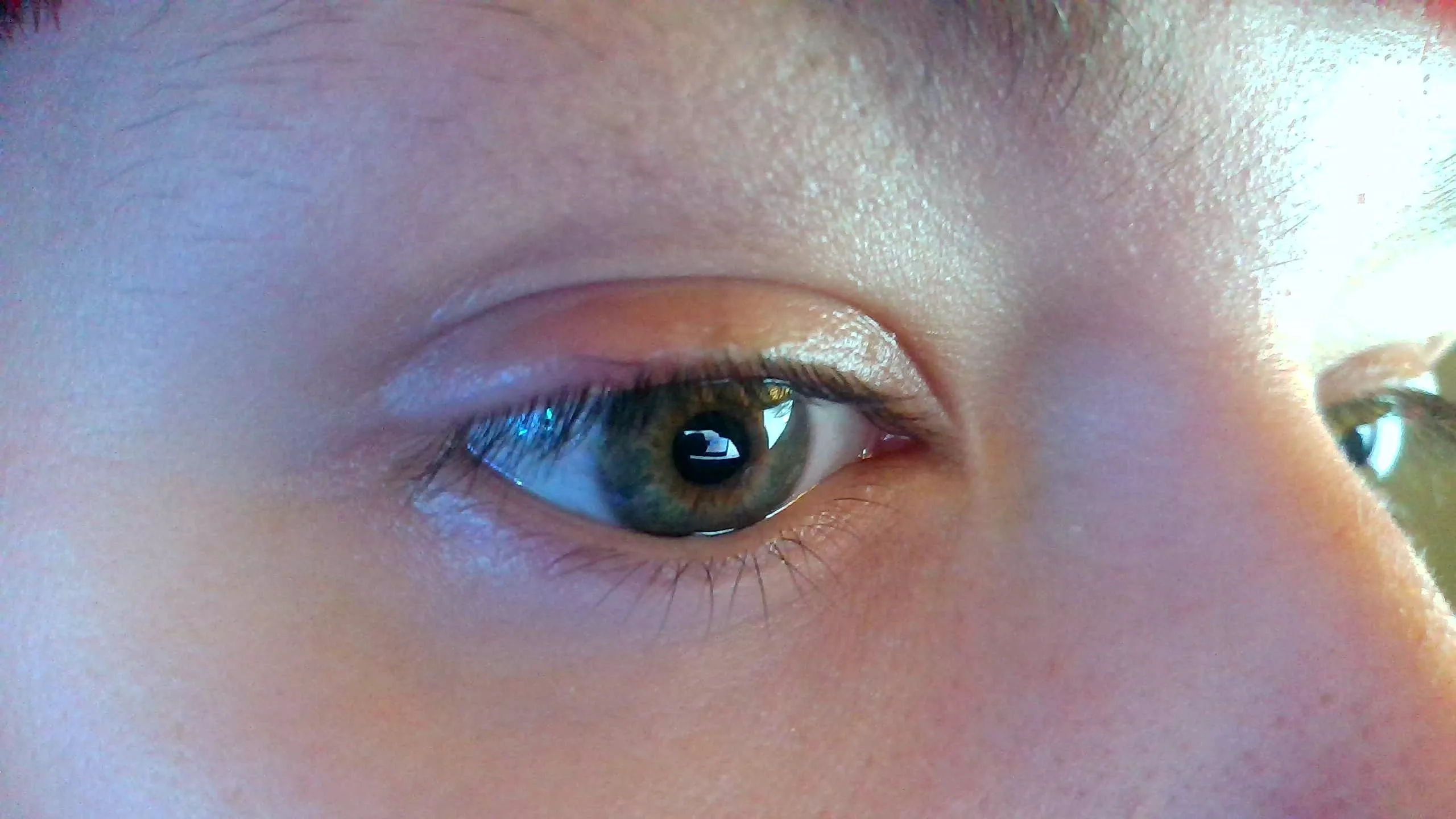 Ingrowing eyelash that is impossible to pluck