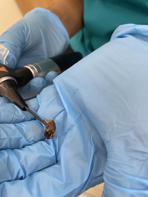 One of the chunks of earwax the nurse removed from my ears today