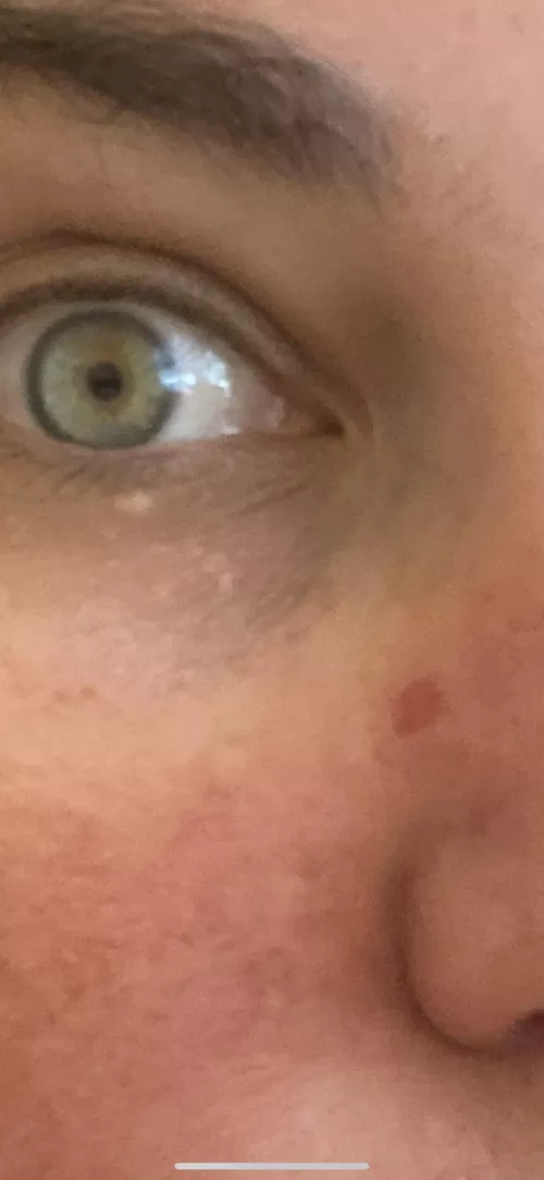Noticed a pimple of my nose about 1-2 months ago and tried to pop it a few weeks ago. Went to the dermatologist for my annual checkup this week and turns out, that “pimple” is actually basal cel carcinoma. I popped my skin cancer. (Pic is after the b