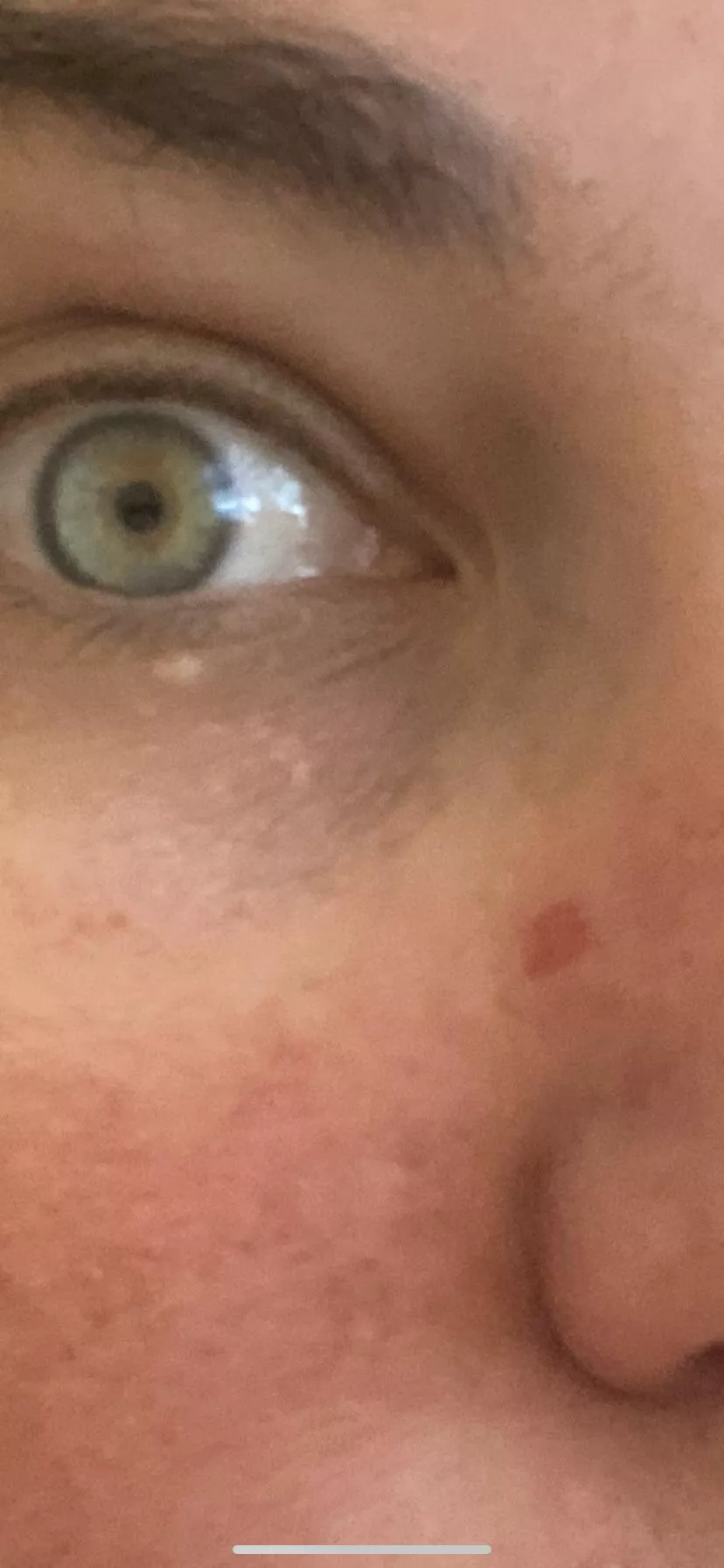 Noticed a pimple of my nose about 1-2 months ago and tried to pop it a few weeks ago. Went to the dermatologist for my annual checkup this week and turns out, that “pimple” is actually basal cel carcinoma. I popped my skin cancer. (Pic is after the b
