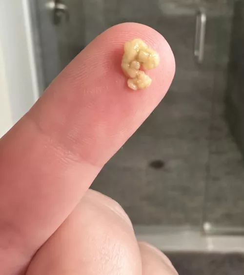 (OC) Big ole tonsil stone
